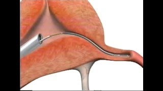 Essure