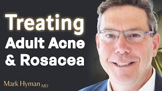 Treating Adult Acne & Rosacea From The Inside Out