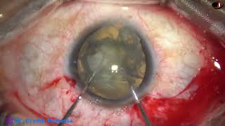 Managing a Cataract with Microcornea, coloboma iris and weak zonule : Pradip Mohanta, 12 Nov, 2022