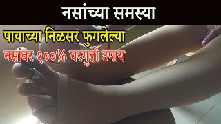 पायांच्या  निळसर पडलेल्या आणि फुगलेल्या नसांवरती घरगुती उपाय |