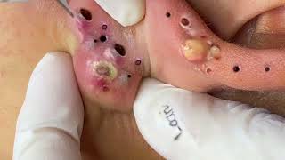 Big Cystic Acne Blackheads Extraction Blackheads \u0026 Milia, Whiteheads Removal Pimple Popping