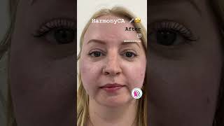 HArmonyCa fillers for facial harmony