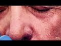 nose blackheads extracted contour dermatology