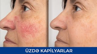 Kuperoz - Üzdə Kapilyarlar - Problemli dəri - Ceyhun Badirov (Dermatoveneroloq - kosmetoloq )