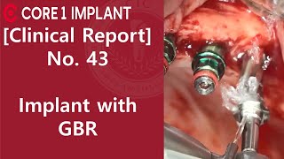 [CYBERMED Clinical Report] #13, 14, 21, 23, 24, 25, 26 implant with GBR