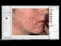 Using GIMP to get rid of acne