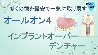 多くの歯を、最安で一気に取り戻す治療法【オールオン４】【インプラントオーバーデンチャー】