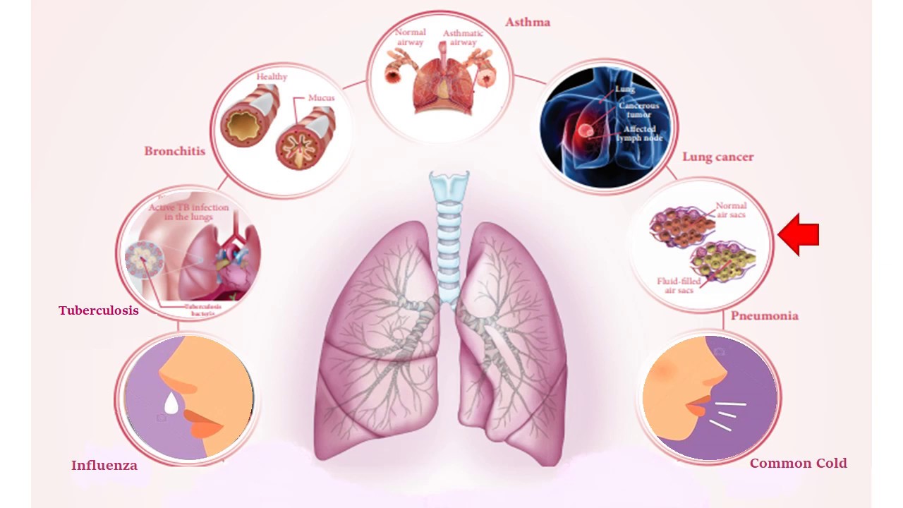 Science - Respiratory Diseases / Disorders Of Respiratory System ...