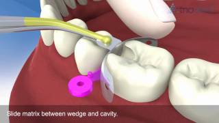 Triodent's V3 Sectional Matrix System