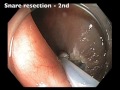 Colonoscopy: Cecum - Polyp - EMR