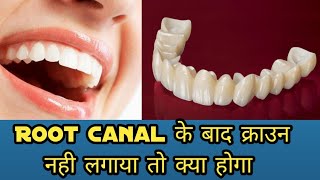 Rct के बाद क्राउन लगाए की नहीं || Dental Crown after Root canal Treatment