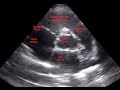 Parasternal Short Axis View Aortic Level - Loop