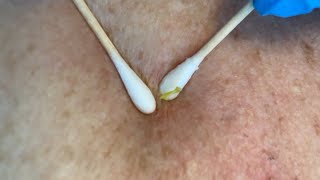 Pimple Popping Trio (Comedone Extraction) | CONTOUR DERMATOLOGY