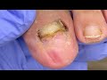 the toenails are damaged in a large area and should be cut off completely dr. liu s pedicur