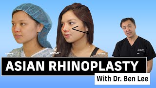 Asian Rhinoplasty! | Wave Plastic Surgery