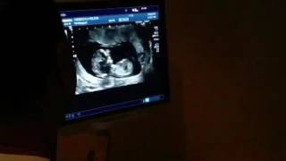 Baby's 12 wk ultrasound