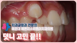 송곳니 덧니가 심해요! 덧니교정후기