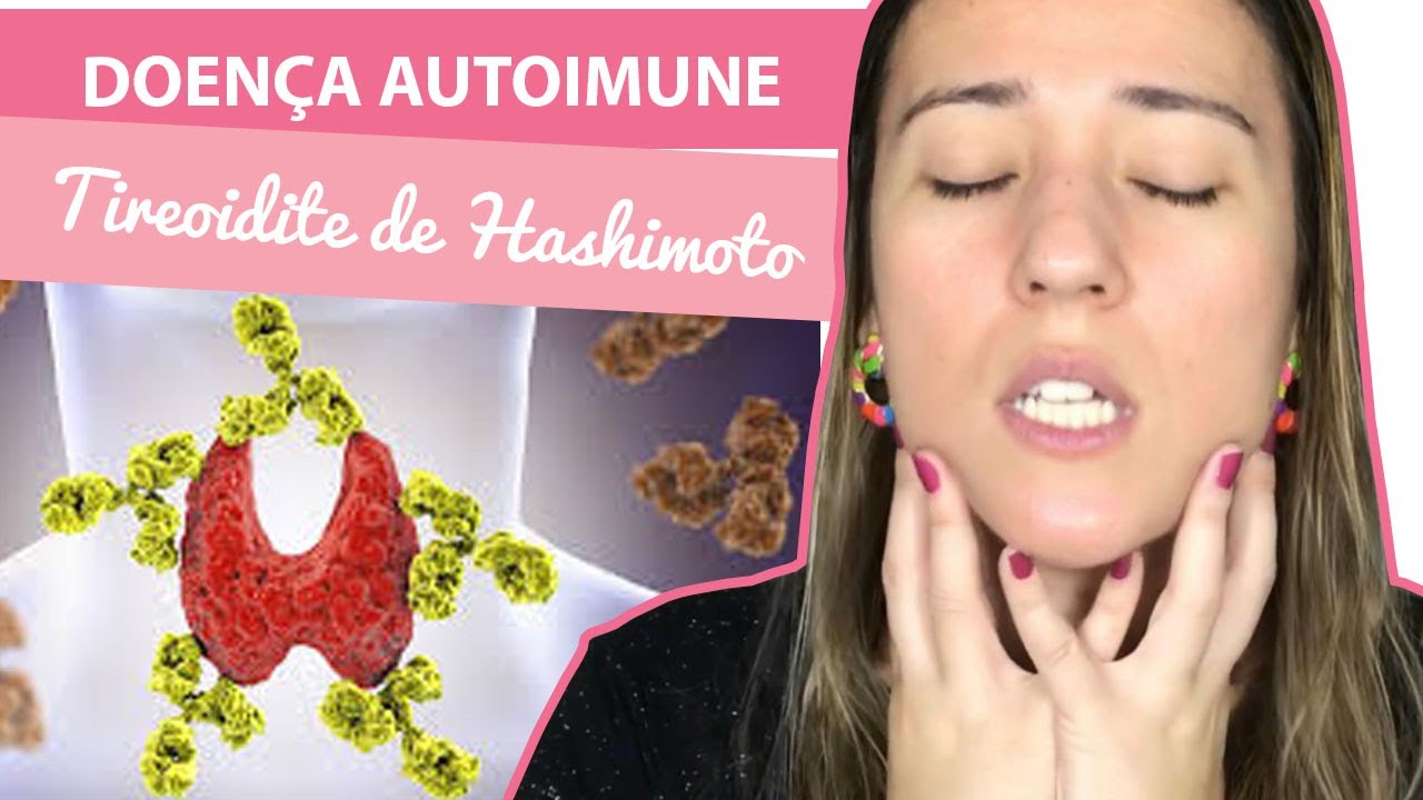 Vencendo A Doença Autoimune! Tireoidite De Hashimoto - YouTube