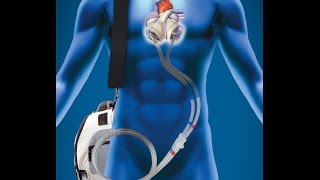 Man Lives 555 Days Without a Human Heart (Portable Artificial Heart)