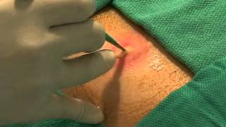 NEJM Abscess Incision and Drainage