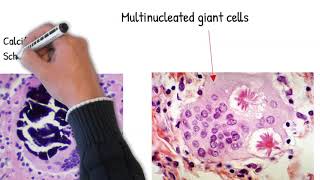 Sarcoidosis easy explained; causes, mechanism and pathology