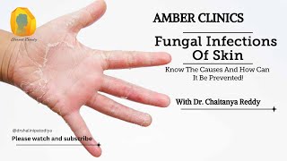 చర్మం యొక్క ఫంగల్ ఇన్ఫెక్షన్ | Fungal Infection of Skin | Causes \u0026 Treatment | In Telugu