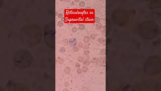 Reticulocytes in Supravital staining |New Methylene Blue