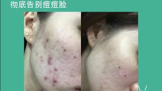 Acne treatment with special price!