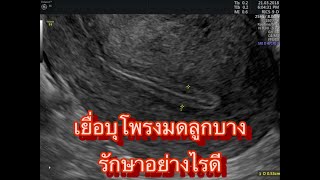 รักษามีบุตรยาก พ ญ  สุชาดา มงคลชัยภักดิ์ Chada IVF on 2022 10 09 at 14 02 37