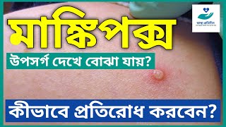 Monkeypox In India | Symptoms| How To Prevent | মাঙ্কিপক্স, উপসর্গ দেখে বোঝা যায়?| কীভাবে প্রতিরোধ?