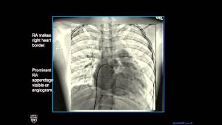 Plain Film Cardiac and Vascular Anatomy - Frontal Radiograph - Philip Araoz, M.D. - Part 4 of 10