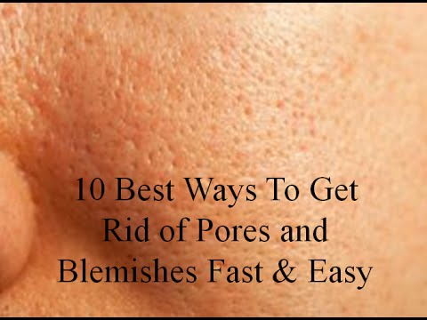 10 Best Ways to get Rid of Pores and Blemishes Fast & Easy 10 Best Ways to get Rid of Pores and Blemishes Fast & Easy