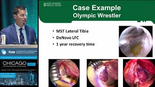 Treating an Athlete with Cartilage Defect from 2017 Chicago Sports Medicine Symposium