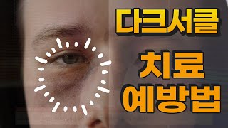 다크서클 색과 형태를 치료해야 하는 경우 치료방법 ｜다크서클 예방 지우기