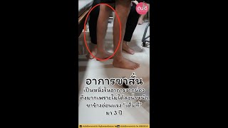 อาการขาสั่นในคนไข้โรคหลอดเลือดสมอง l เดินดีคลินิกกายภาพบำบัด