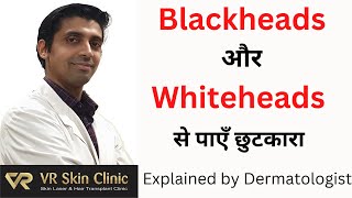 Blackheads और Whiteheads का ईलाज | How to cure Acne | VR Skin Clinic | Bikaner | Dr Vineet |Dr Rekha