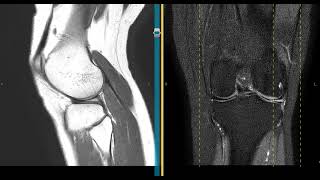 Mucoid degeneration of the lateral meniscus