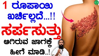 ಸರ್ಪಸುತ್ತು ಆಗಿರುವ ಜಾಗಕ್ಕೆ ಹೀಗೆ ಮಾಡಿ | Sarpa Suttu Symptoms in Kannada | Sarpa Hunnu Mane Maddu