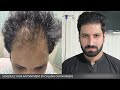 hair transplant at very young age