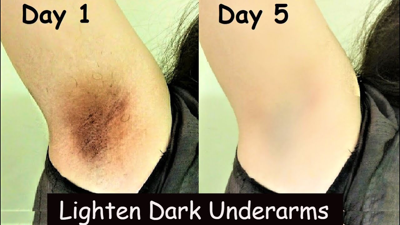 Lighten Dark Underarms In 5 Days - Dark Underarms Whitening Turmeric ...