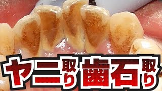 [膿がスゴい]ヤニ取り～歯石取り[Tartar removal][喫煙者]歯石Vol.6(去除煙垢去除牙石)