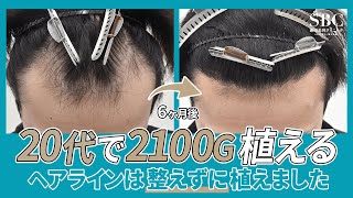 【20代の植毛】この生え際で大丈夫？不整なデザインで自然な仕上がり