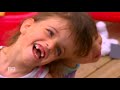 Conjoined twins share taste, sight, feelings and thoughts  60 Minutes Australia