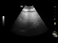 moderate hepatic steatosis grade ii fatty liver ultrasound case 222