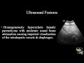 moderate hepatic steatosis grade ii fatty liver ultrasound case 222