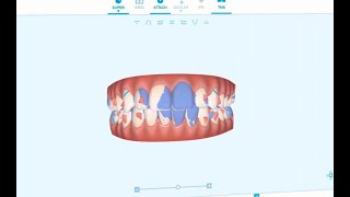 Como funciona o INVISALIGN!!!