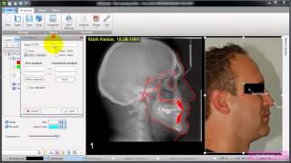 AudaxCeph - Superimposition of an image