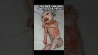 Rare disease you could have (Harlequin-type ichthyosis) #shorts