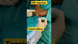 PRP Injection Elbow Live ✓✓ | #prp #elbow_pain #elbowjointpain #plateletrichplasma #tenniselbow |