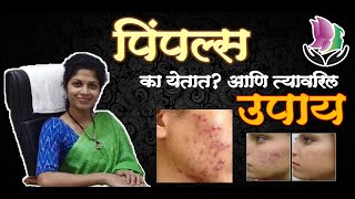 पिंपल्स का येतात? आणि त्यावरील उपाय | How to Prevent Pimples ?